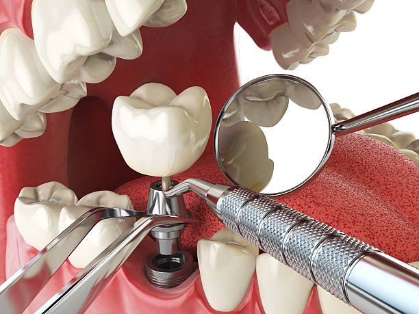 Best Emergency Tooth Extraction in Oak Park, CA